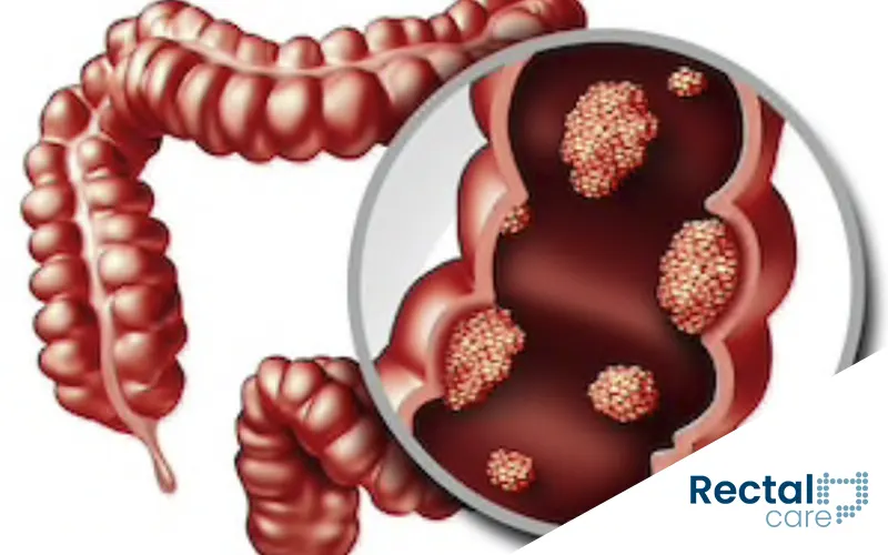 Tumor de reto: histórias reais de superação e diagnóstico precoce