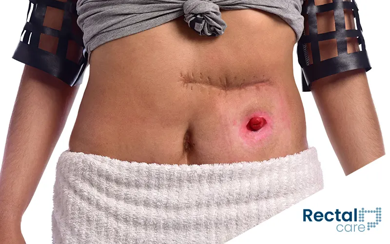 Cirurgia de Colostomia: Depoimentos de Quem Passou pelo Procedimento