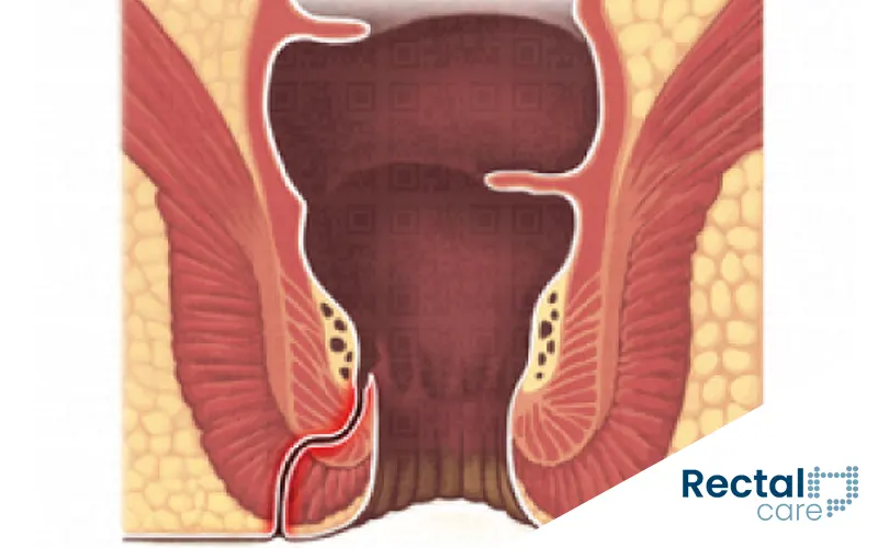 Fístula anal tem cura? Saiba tudo sobre o tratamento e a recuperação