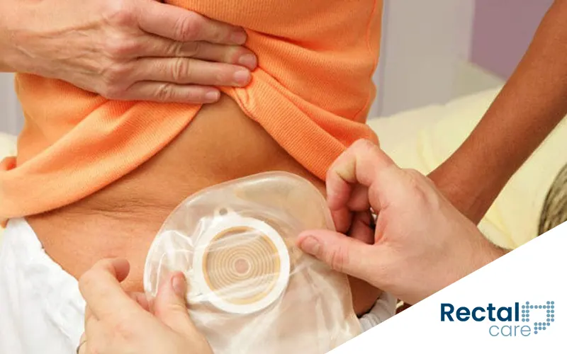 Irrigação de colostomia esquerda: mais autonomia, mais qualidade de vida