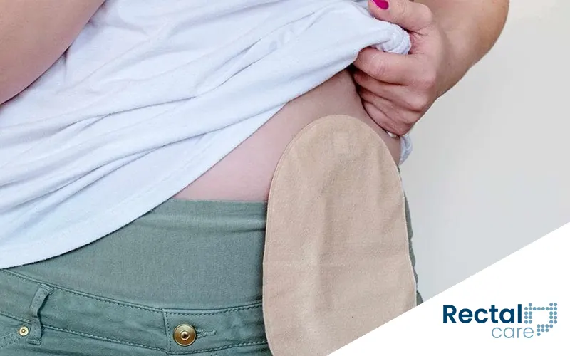 Tudo o que você precisa saber sobre cirurgia de ileostomia
