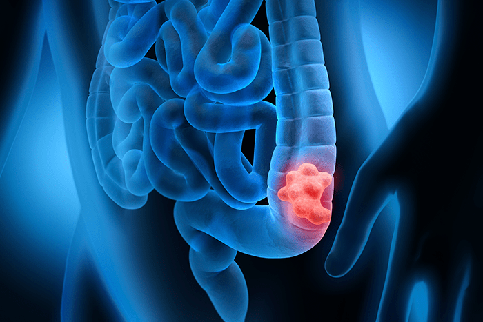 Porque é fundamental fazer prevenção contra o câncer de intestino mesmo sem sintomas 