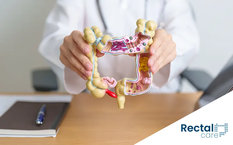Porque é fundamental fazer prevenção contra o câncer de intestino mesmo sem sintomas 