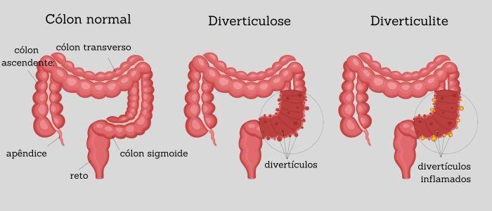 qual-a-diferenca-entre-doenca-diverticular-e-diverticulite