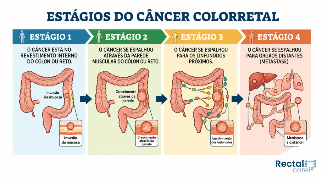Entenda o que acontece em cada um dos estágios do câncer colorretal