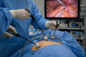Cirurgia para câncer de cólon: o que define a extensão da retirada